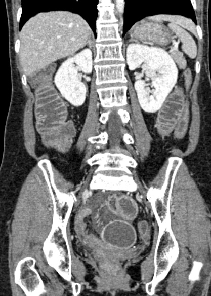 Adhesional small bowel obstruction (Radiopaedia 48397-53305 Coronal C+ portal venous phase 230).jpg