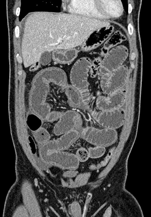 Adhesional small bowel obstruction (Radiopaedia 58900-66131 Coronal C+ portal venous phase 97).jpg
