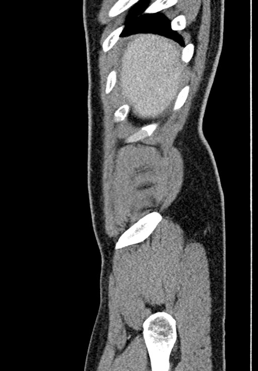 Adhesional small bowel obstruction (Radiopaedia 58900-66131 Sagittal C+ portal venous phase 22).jpg