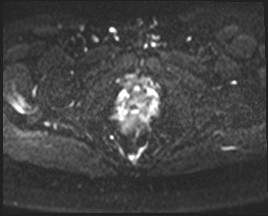 Adnexal multilocular cyst (O-RADS US 3- O-RADS MRI 3) (Radiopaedia 87426-103754 Axial DWI 21).jpg