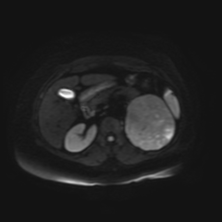 Adrenal cortical carcinoma (Radiopaedia 70906-81116 Axial DWI 12).jpg