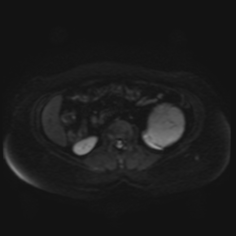 Adrenal cortical carcinoma (Radiopaedia 70906-81116 Axial DWI 18).jpg