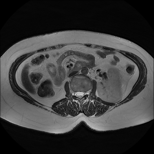 File:Adrenal cortical carcinoma (Radiopaedia 70906-81116 Axial T2 25).jpg