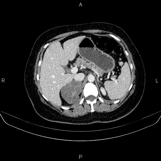 Adrenal cortical carcinoma (Radiopaedia 84882-100379 Axial C+ portal venous phase 25).jpg