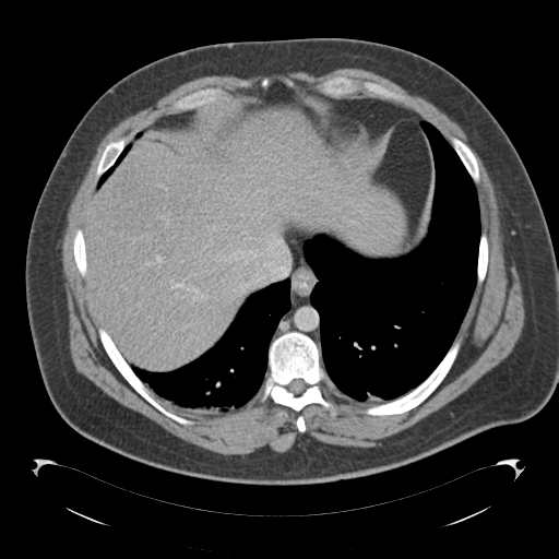 File:Adrenal cyst (Radiopaedia 45625-49776 Axial C+ portal venous phase 14).png