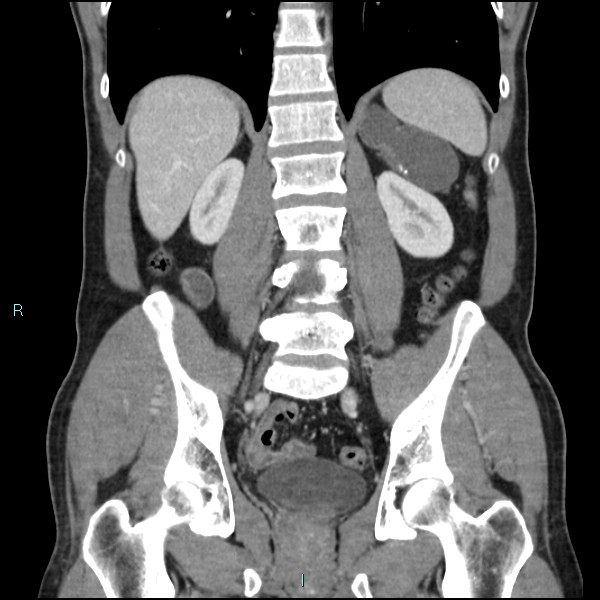 Adrenal cystic lymphangioma (Radiopaedia 83161-97534 Coronal C+ portal venous phase 50).jpg