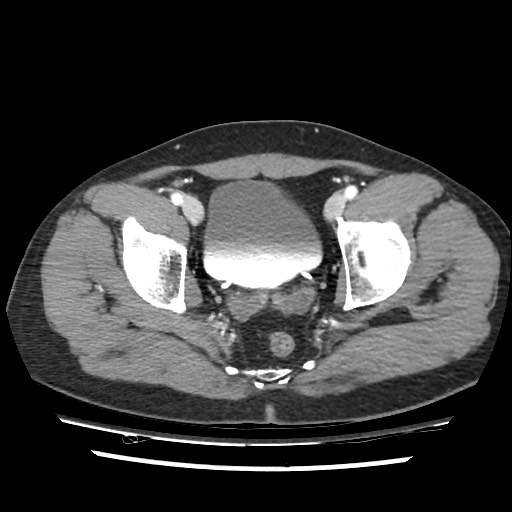 Adrenal gland trauma (Radiopaedia 81351-95078 Axial Dual bolus trauma C+ 113).jpg