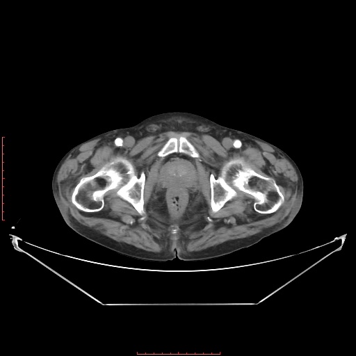 Adrenal hemangioma (Radiopaedia 68923-78668 Axial C+ arterial phase 73).jpg