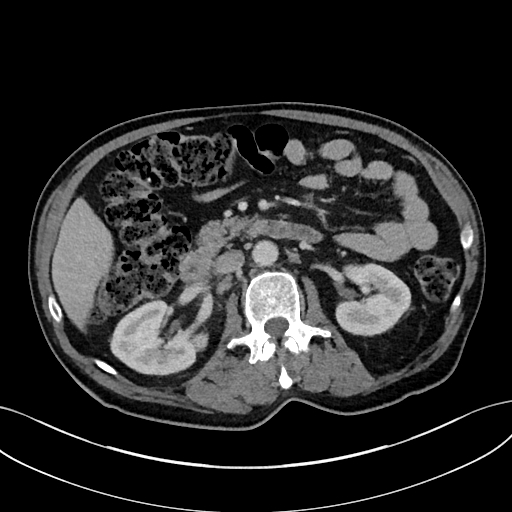 File:Adrenal lymphoma (Radiopaedia 73730-84529 Axial C+ portal venous phase 49).jpg
