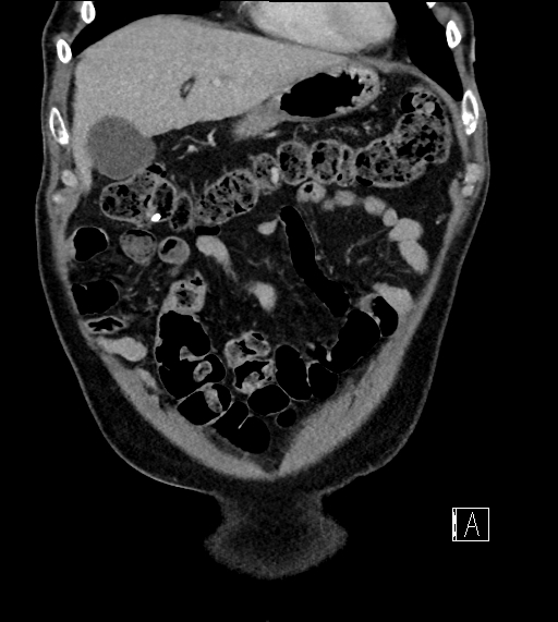 Adrenal lymphoma (Radiopaedia 73730-84529 Coronal C+ portal venous phase 18).jpg