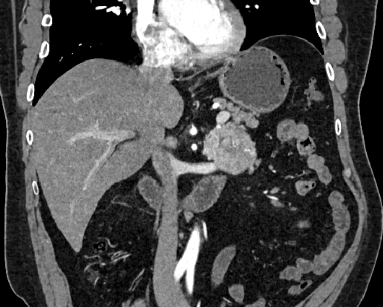 Adrenal metastases (Radiopaedia 73082-83791 Coronal C+ arterial phase 14).jpg