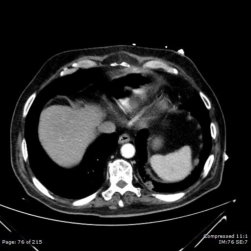 Adrenal metastasis (Radiopaedia 78425-91079 Axial C+ arterial phase 6).jpg