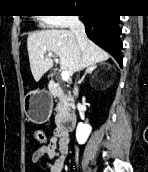 Adrenal myelolipoma (Radiopaedia 82742-96986 Sagittal renal cortical phase 46).jpg