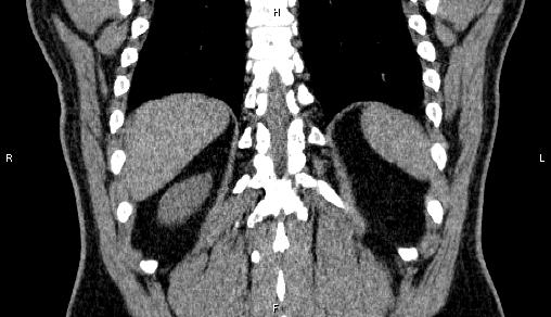 File:Adrenal myelolipoma (Radiopaedia 84321-99619 Coronal non-contrast 65).jpg