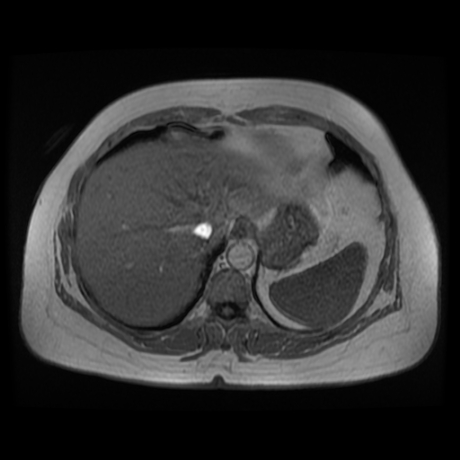 File:Adrenal myelolipoma - MRI (Radiopaedia 83249-97646 Axial T1-in phase 2).jpg