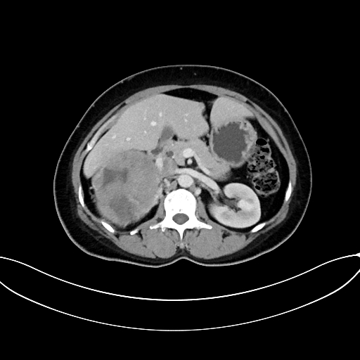 Adrenocortical carcinoma (Radiopaedia 87281-103569 Axial C+ portal venous phase 34).jpg