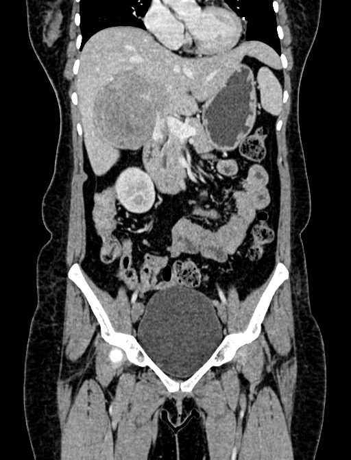 Adrenocortical carcinoma (Radiopaedia 87281-103569 Coronal C+ portal venous phase 24).jpg