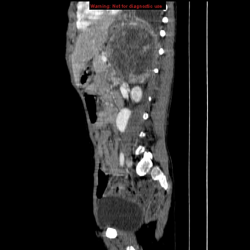 File:Adrenocortical carcinoma (Radiopaedia 9449-10131 Sagittal C+ portal venous phase 10).jpg