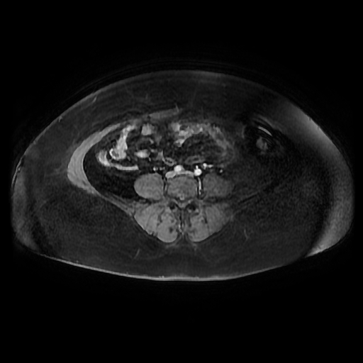 File:Adult granulosa cell tumor of the ovary (Radiopaedia 64991-73953 axial-T1 Fat sat post-contrast dynamic 65).jpg