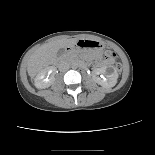 File:Adult polycystic kidney disease (Radiopaedia 48845-53876 Axial renal excretory phase 46).jpg