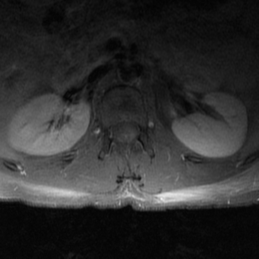 File:Aggressive vertebral hemangioma (Radiopaedia 39937-42404 Axial T1 C+ fat sat 1).png