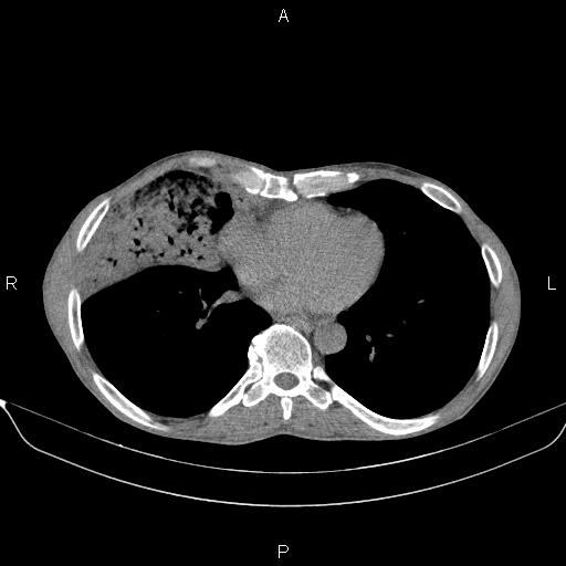 File:Air bronchogram in pneumonia (Radiopaedia 85719-101512 Axial non-contrast 44).jpg