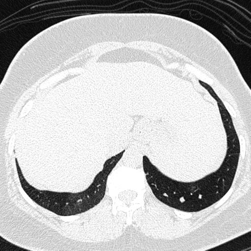 File:Air trapping in small airway disease (Radiopaedia 61685-69694 Axial lung window 175).jpg