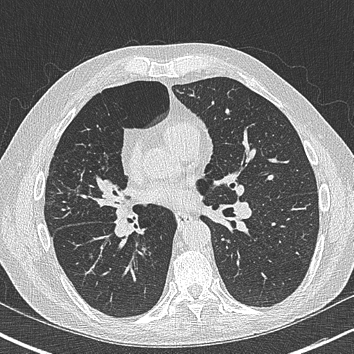 File:Allergic bronchopulmonary aspergillosis (Radiopaedia 44760-48571 Axial lung window 36).png