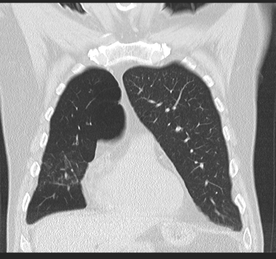 Allergic bronchopulmonary aspergillosis (Radiopaedia 44760-48571 Coronal lung window 18).png