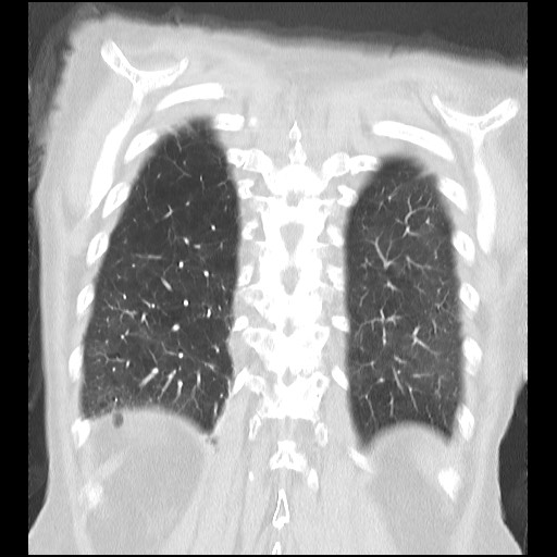 File:Alpha-1-antitrypsin deficiency (Radiopaedia 64893-73840 Coronal lung window 31).jpg