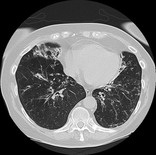 Alpha-1-antitrypsin deficiency (Radiopaedia 72058-82557 Axial lung window 50).jpg
