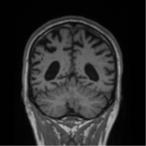 Alzheimer's disease- with Gerstmann syndrome and dressing apraxia (Radiopaedia 54882-61150 Coronal T1 26).png