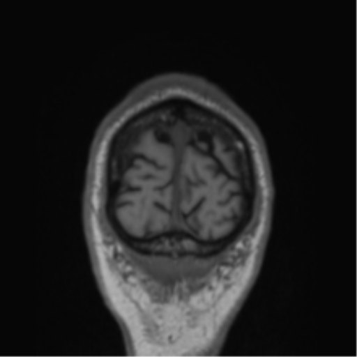 File:Alzheimer's disease- with Gerstmann syndrome and dressing apraxia (Radiopaedia 54882-61150 Coronal T1 6).png