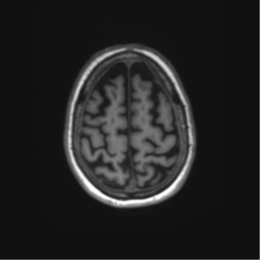 File:Alzheimer's disease (Radiopaedia 42658-45802 Axial T1 32).png