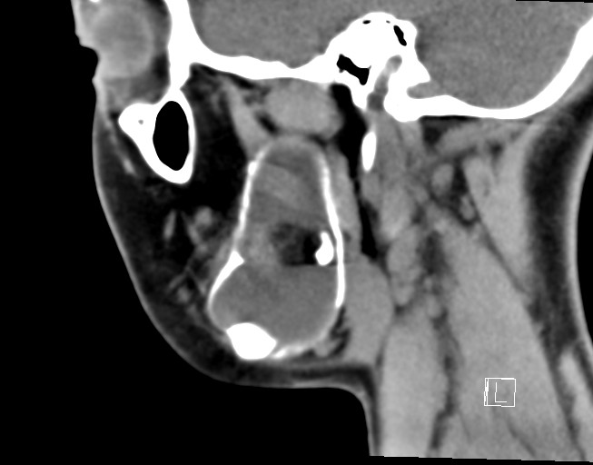 File:Ameloblastoma (Radiopaedia 26645-26793 Sagittal C+ delayed 8).jpg