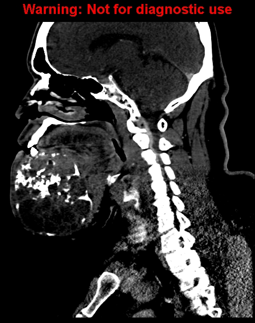 Ameloblastoma (Radiopaedia 33126-34164 F 34).jpg