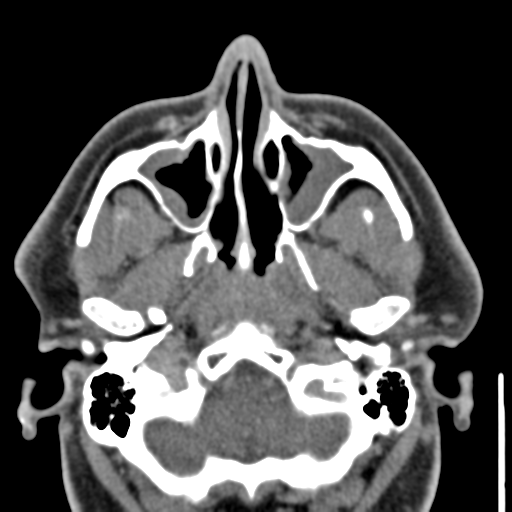 File:Ameloblastoma (Radiopaedia 33677-34806 Axial non-contrast 6).png