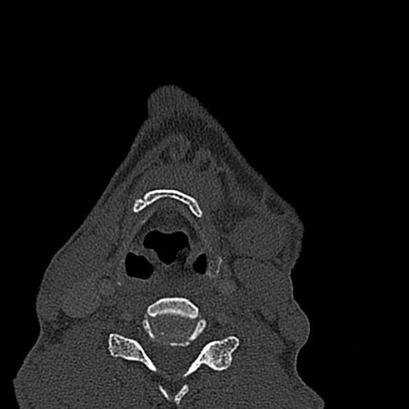 Ameloblastoma (Radiopaedia 51921-57766 Axial bone window 8).jpg