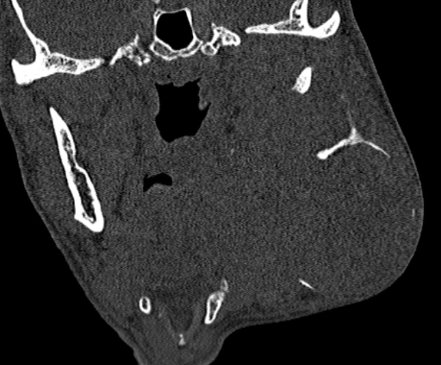 Ameloblastoma (Radiopaedia 51921-57766 Coronal bone window 154).jpg
