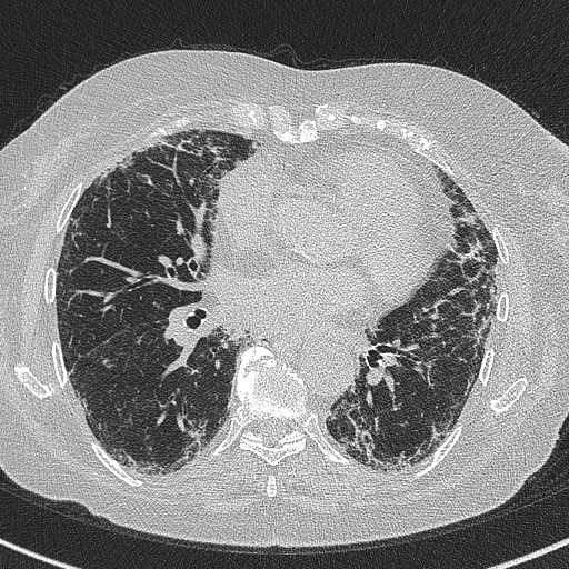 Amiodarone-induced pulmonary fibrosis (Radiopaedia 82355-96460 Axial lung window 40).jpg