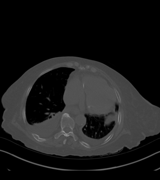 Amiodarone deposition in the liver (Radiopaedia 77587-89780 Axial bone window 60).jpg