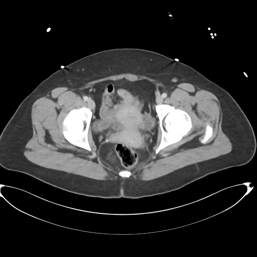 File:Amoebic liver abscess (Radiopaedia 52611-58530 A 91).png