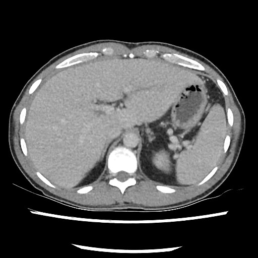 File:Amoebic liver abscesses (Radiopaedia 55536-62010 A 24).jpg