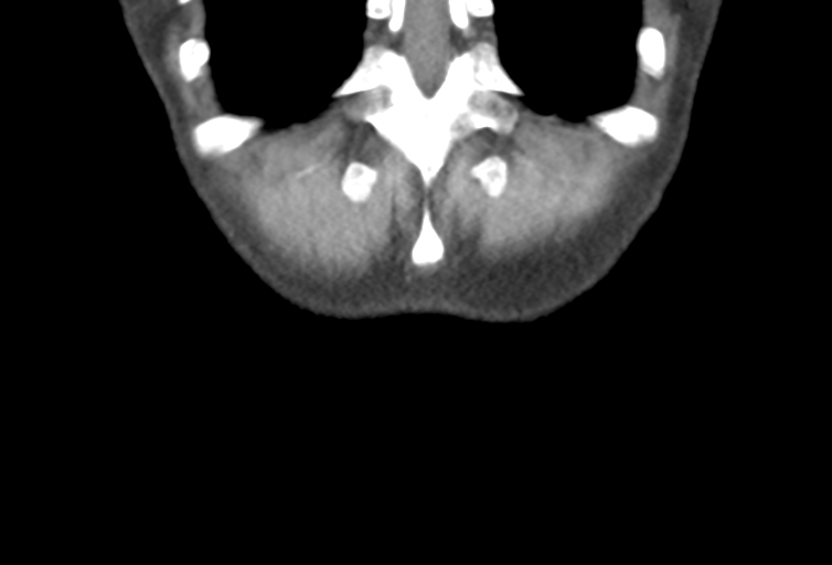 Ampullary adenocarcinoma (Radiopaedia 34013-35241 Coronal 52).png
