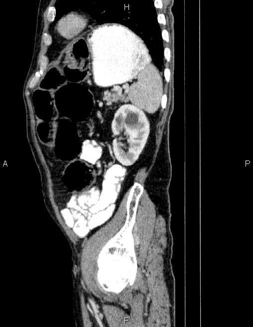 Ampullary adenocarcinoma (Radiopaedia 86093-102032 D 77).jpg