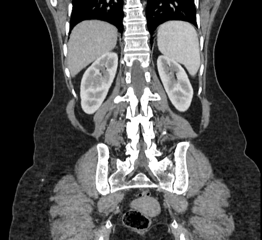 File:Ampullary tumor (Radiopaedia 60333-67998 B 60).jpg