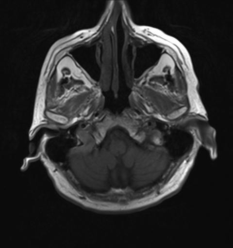 File:Amyloid angiopathy with inflammation (Radiopaedia 30360-31002 Axial T1 4).jpg
