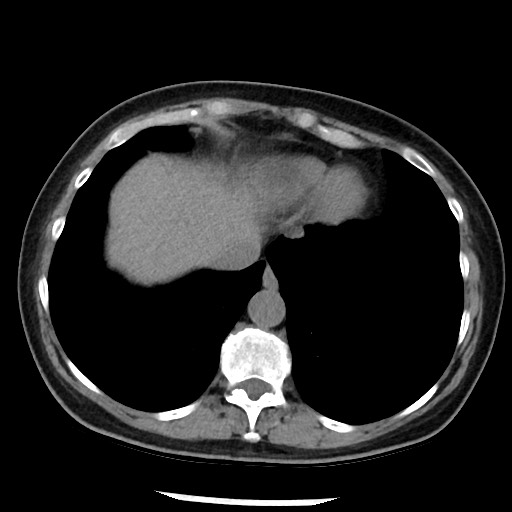 Amyloidosis - bronchial and diffuse nodular pulmonary involvement (Radiopaedia 60156-67744 Axial non-contrast 46).jpg
