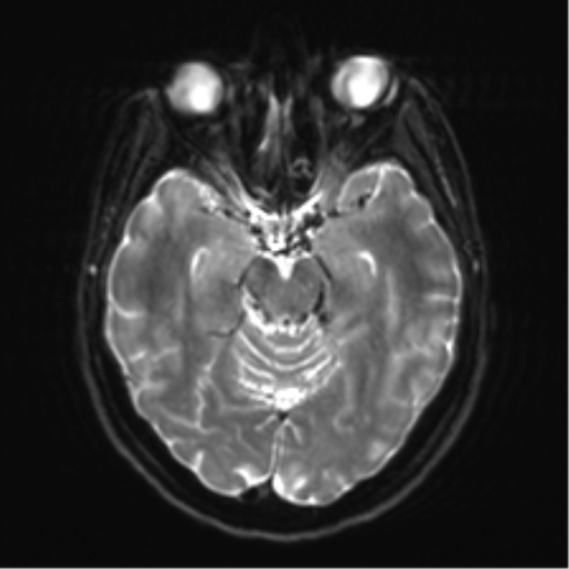 Anaplastic astrocytoma - thalamic glioma (Radiopaedia 59709-67115 Axial DWI 13).png