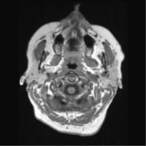 File:Anaplastic astrocytoma IDH wild-type (pseudoprogression) (Radiopaedia 42209-45276 Axial T1 13).png